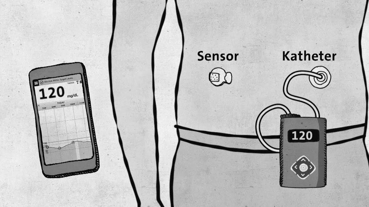 Kind 1 diabetes – trendy technology without approval – good to know